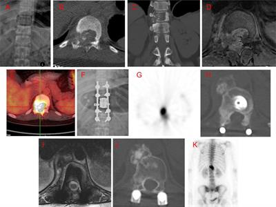 Intralesional Marginal Resection for Osteoblastoma in the Mobile Spine: Experience From a Single Center